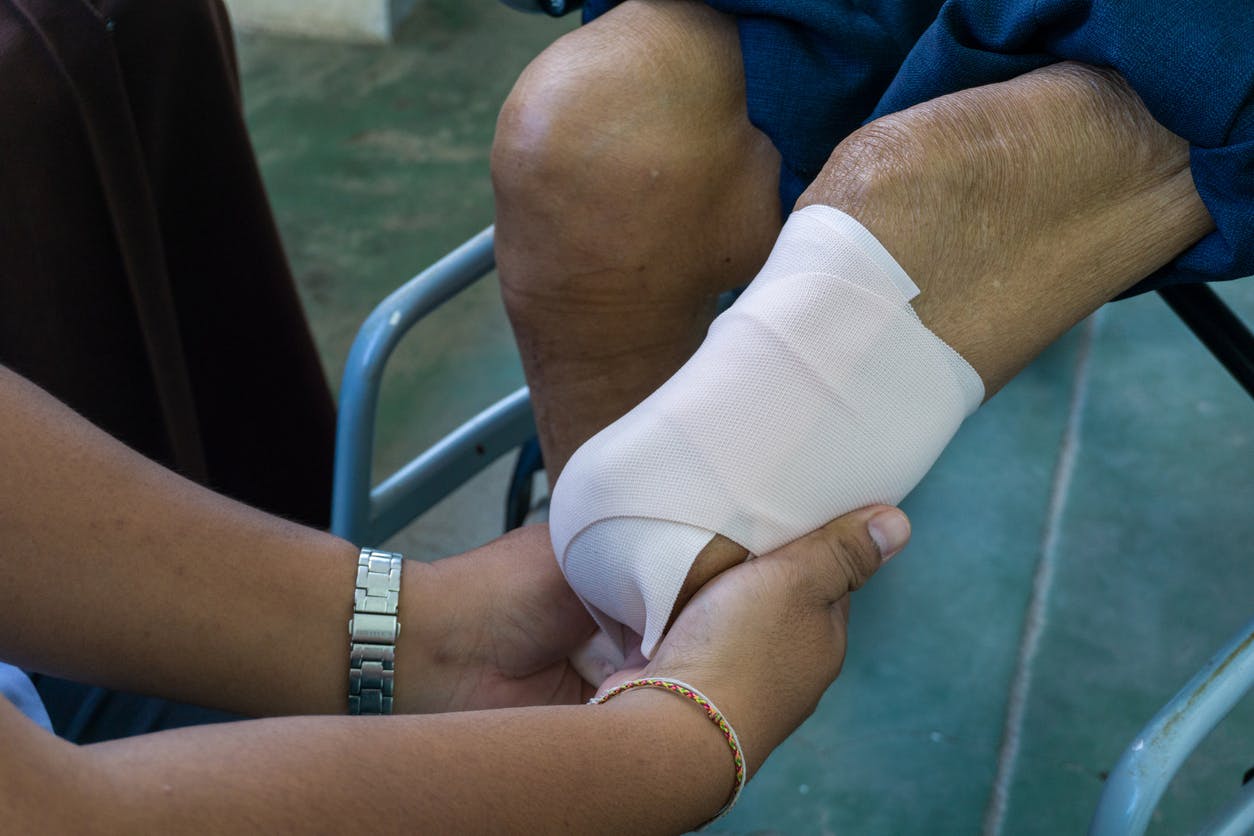 A person with an amputated leg