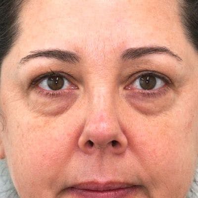 Blepharoplasty Before & After Gallery - Patient 5919154 - Image 1