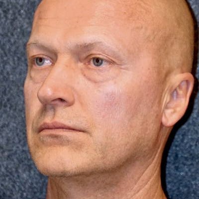 Blepharoplasty Before & After Gallery - Patient 5919155 - Image 1