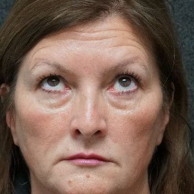 Blepharoplasty Before & After Gallery - Patient 5919156 - Image 1