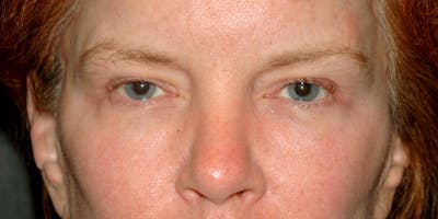 Blepharoplasty Before & After Gallery - Patient 5919158 - Image 1