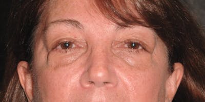 Blepharoplasty Before & After Gallery - Patient 5919159 - Image 1