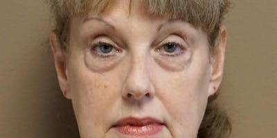 Blepharoplasty Before & After Gallery - Patient 5919383 - Image 1