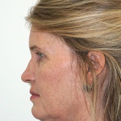 Deep Plane Facelift Before & After Gallery - Patient 339864 - Image 1