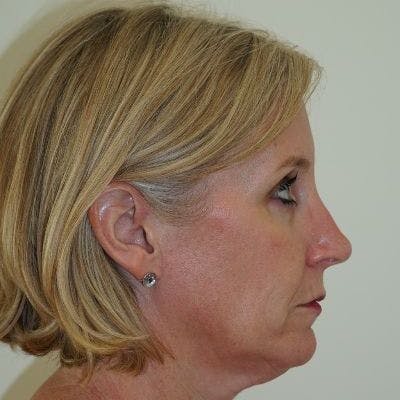 Deep Plane Facelift Before & After Gallery - Patient 311441 - Image 1