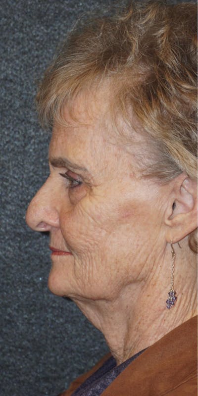 Deep Plane Facelift Before & After Gallery - Patient 317113 - Image 1