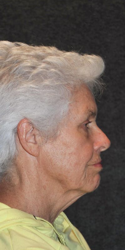 Deep Plane Facelift Before & After Gallery - Patient 352166 - Image 1