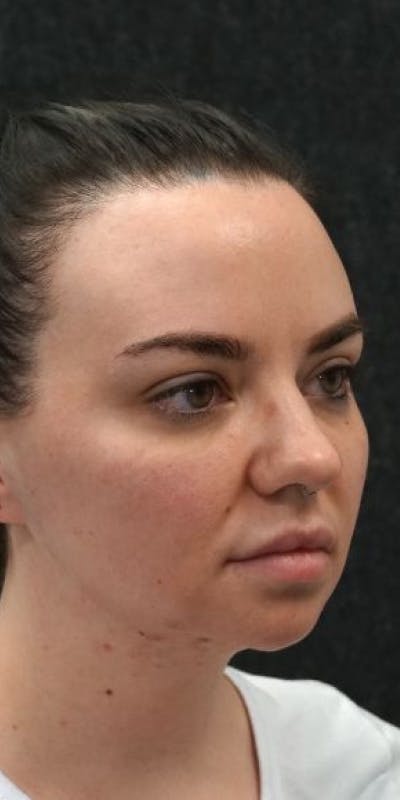 Jawline Surgery Before & After Gallery - Patient 5922120 - Image 1
