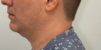 Jawline Surgery Before & After Gallery - Patient 5922121 - Image 1