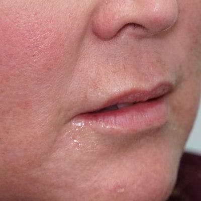 Before and after Restylane in Nashville at Refine Facial Plastic Surgery