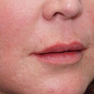 Before and after Restylane in Nashville at Refine Facial Plastic Surgery