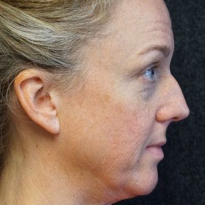 Before and after FaceTite in Nashville at Refine Facial Plastic Surgery