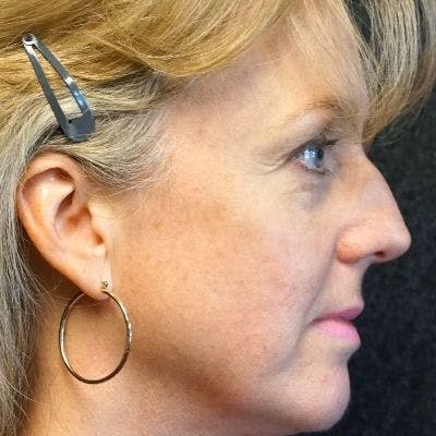 Before and after FaceTite in Nashville at Refine Facial Plastic Surgery