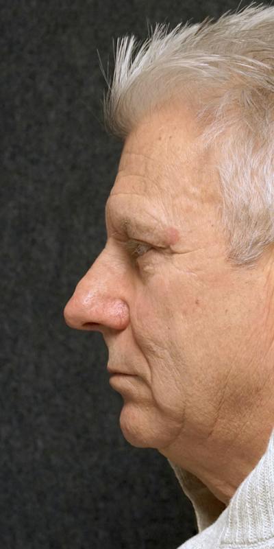 Male Rhinoplasty Before & After Gallery - Patient 5923185 - Image 1