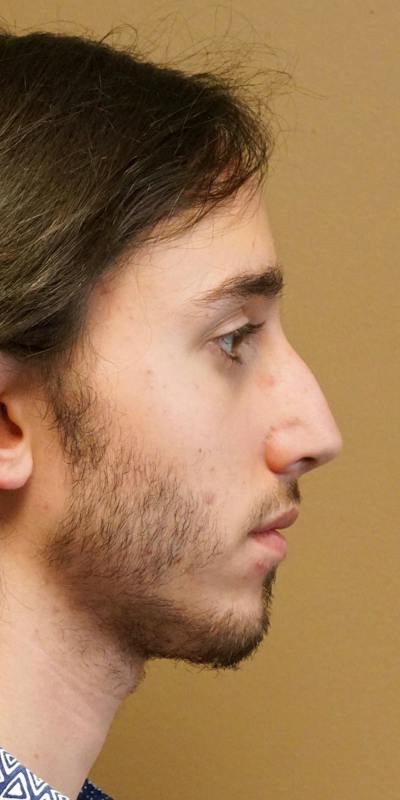 Male Rhinoplasty Before & After Gallery - Patient 5923208 - Image 1