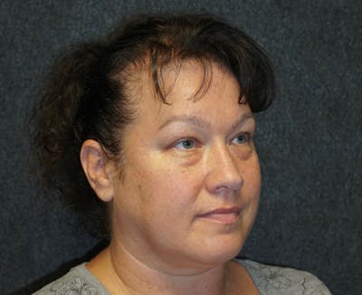Blepharoplasty Before & After Gallery - Patient 15234187 - Image 1