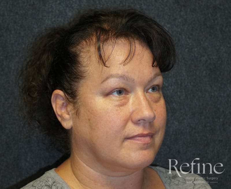 Blepharoplasty Before & After Gallery - Patient 15234187 - Image 1