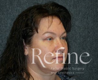 Blepharoplasty Before & After Gallery - Patient 15234187 - Image 2