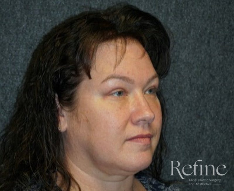 Blepharoplasty Before & After Gallery - Patient 15234187 - Image 2