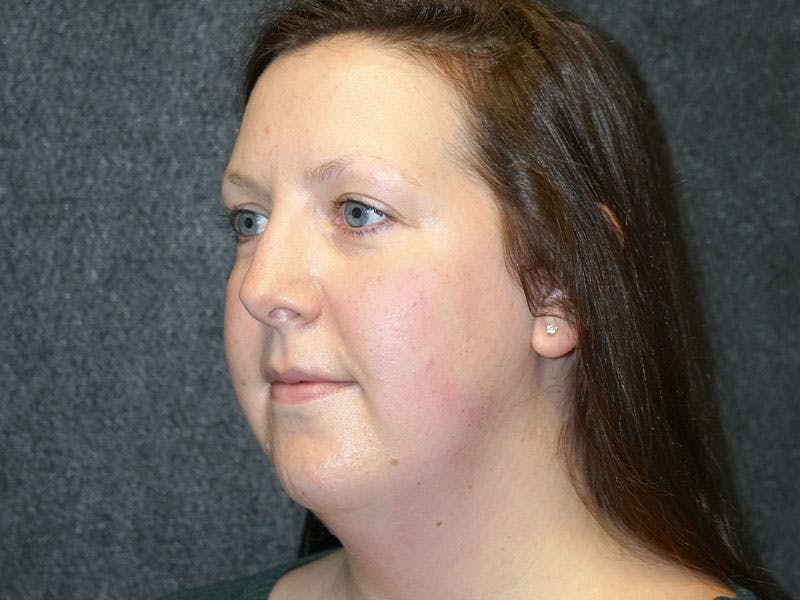 neck liposuction before & after