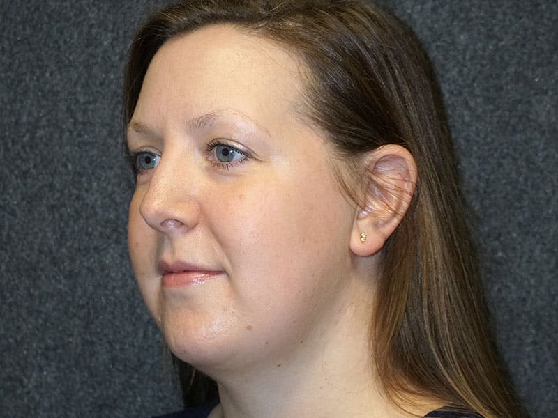 neck liposuction before & after