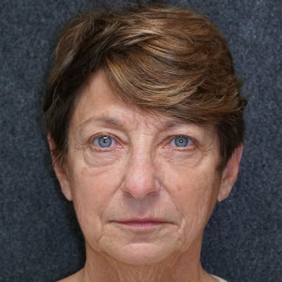 Blepharoplasty Before & After Gallery - Patient 35128000 - Image 1