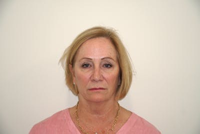 Brow Lift Before & After Gallery - Patient 54509040 - Image 1