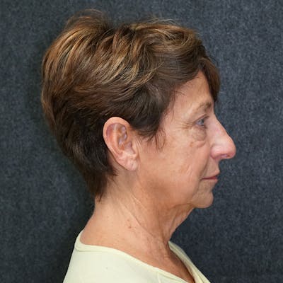 Deep Plane Facelift Before & After Gallery - Patient 319106 - Image 1