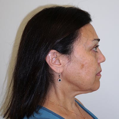Deep Plane Facelift Before & After Gallery - Patient 947051 - Image 1