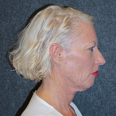 Deep Plane Facelift Before & After Gallery - Patient 55432358 - Image 1