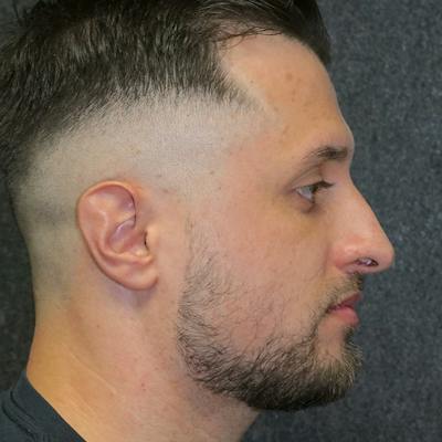 Male Rhinoplasty Before & After Gallery - Patient 54560381 - Image 1
