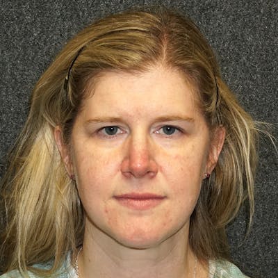 Brow Lift Before & After Gallery - Patient 55959947 - Image 1