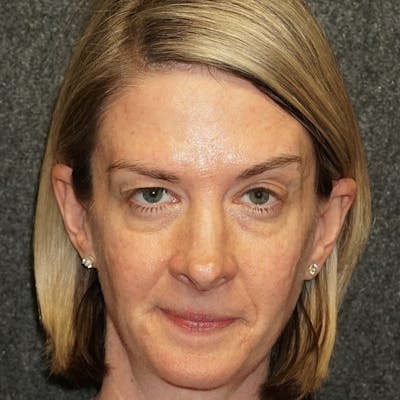 Blepharoplasty Before & After Gallery - Patient 55959994 - Image 1