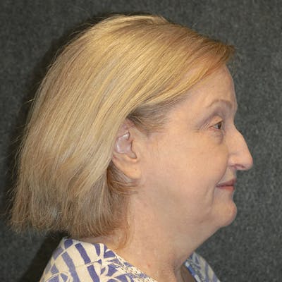 Deep Plane Facelift Before & After Gallery - Patient 56010290 - Image 1