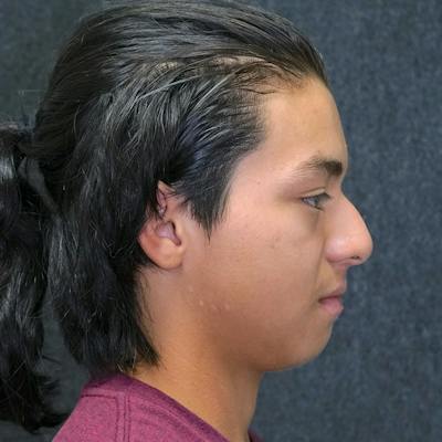 Male Rhinoplasty Before & After Gallery - Patient 56010302 - Image 1