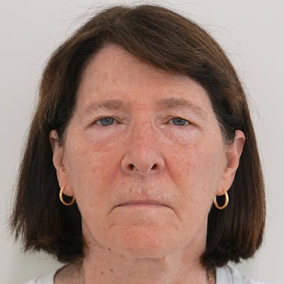 Blepharoplasty Before & After Gallery - Patient 56010370 - Image 1
