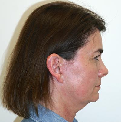 Deep Neck Lift Before & After Gallery - Patient 56093016 - Image 1