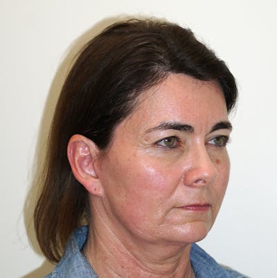 Jawline Surgery Before & After Gallery - Patient 56093070 - Image 1