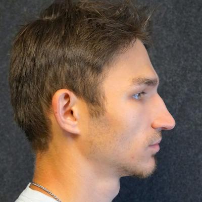 Male Rhinoplasty Before & After Gallery - Patient 5923175 - Image 1