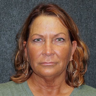 Blepharoplasty Before & After Gallery - Patient 64115037 - Image 1
