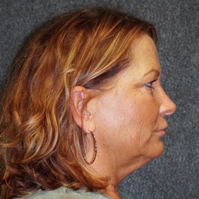 Deep Plane Facelift Before & After Gallery - Patient 705528 - Image 1