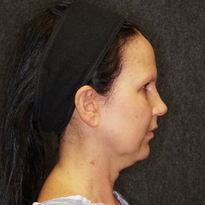 Deep Plane Facelift Before & After Gallery - Patient 278815 - Image 1