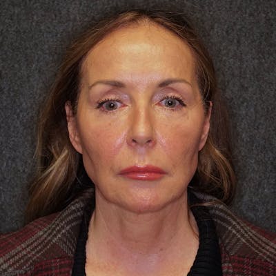 Brow Lift Before & After Gallery - Patient 181816280 - Image 1