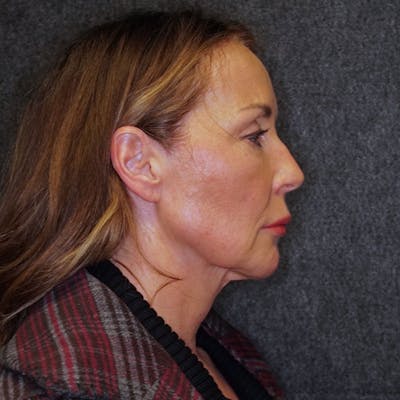 Deep Plane Facelift Before & After Gallery - Patient 181816252 - Image 1