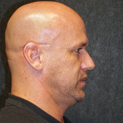 Deep Plane Facelift Before & After Gallery - Patient 181845241 - Image 1