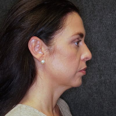 Deep Plane Facelift Before & After Gallery - Patient 689809 - Image 1