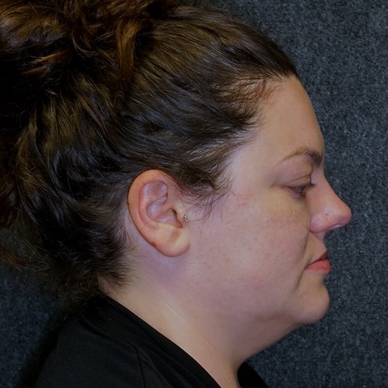 neck liposuction before & after