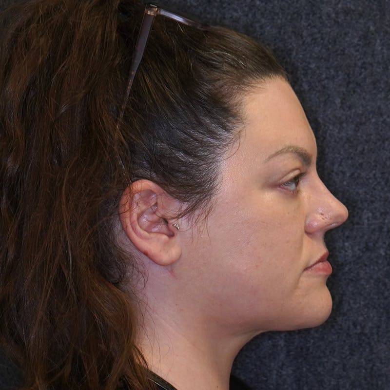 neck liposuction before & after