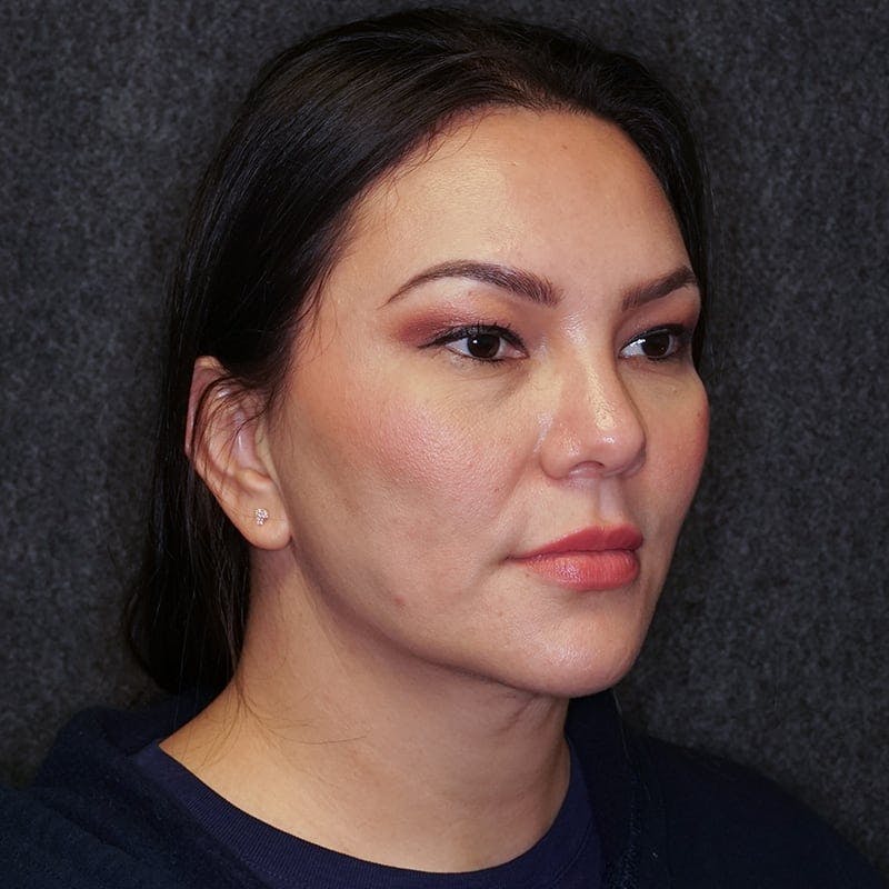 neck liposuction before & after