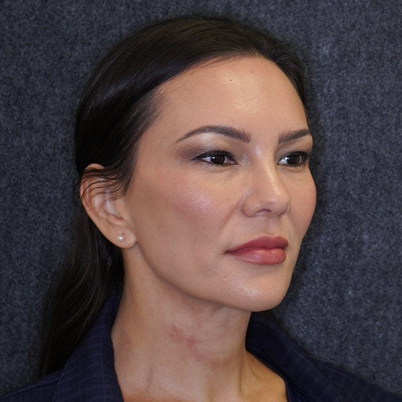 neck liposuction before & after